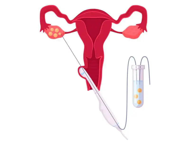 Embryo transfer procedure in IVF treatment