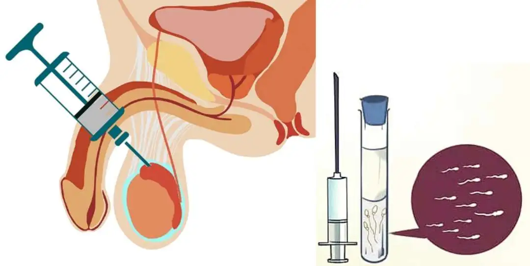 tesa treatment in Patna