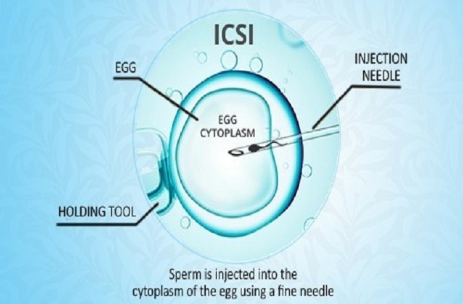 ICSI Treatment Patna