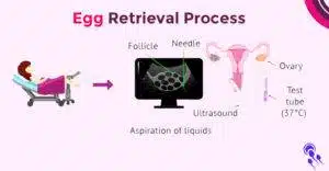 Egg Retrieval Process